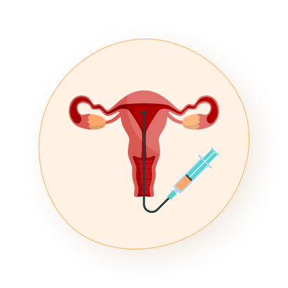 Operative Note Embryo Transfer YourIVFSuccess